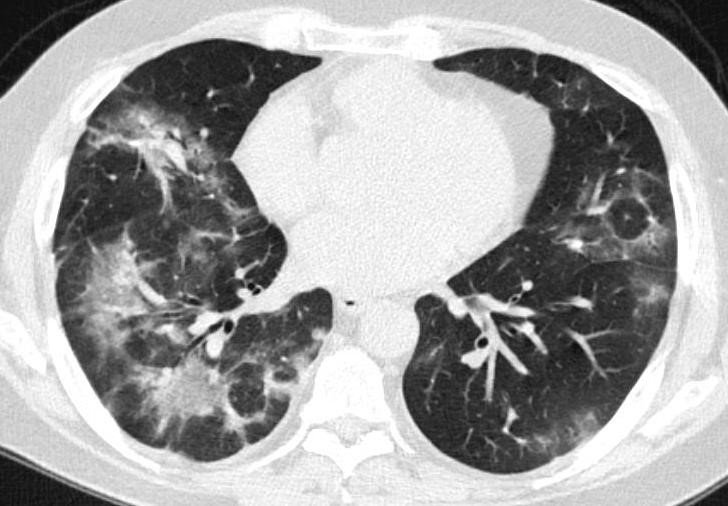 تشخیص کووید-19 با استفاده از تصاویر CT-scan (تحقیق و بررسی)