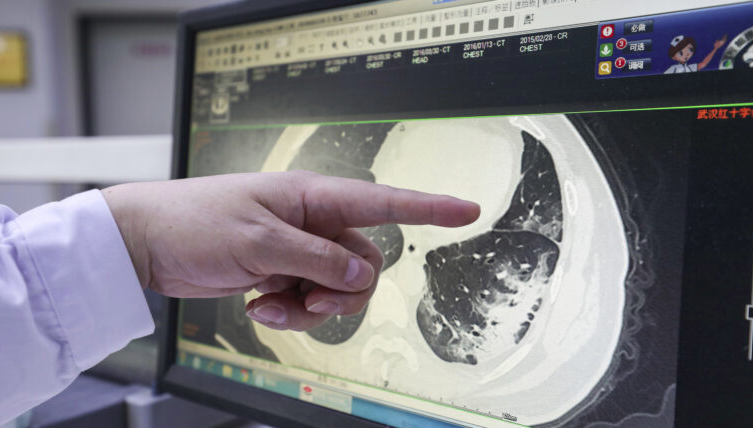 تشخیص کووید-19 با استفاده از تصاویر CT-scan (توسعه)